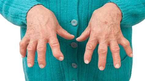 deforme artrit nasıl tedavi edilir